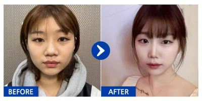 [강남언니 후기] 코성형 / 3개월차 / 닉네임:웅낭난