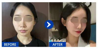 [강남언니 후기] 윤곽3종(광대,턱끝,사각턱), 가슴(멘토스무스) / 3개월차 / 닉네임:크루루루삥뽕