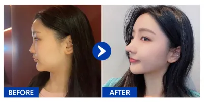 [강남언니 후기] 코성형 / 1개월차 / 닉네임:닝이쿠쿠당