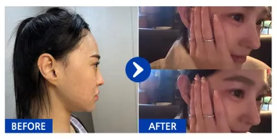 [강남언니 후기] 코재수술 / 3주차 / 닉네임:하이루익바