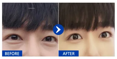 [강남언니] 눈밑지방재배치 1개월차 / 닉네임 : 크리스으