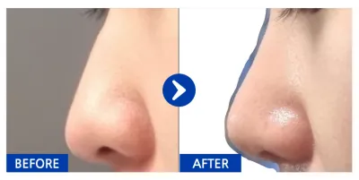 [강남언니] 코 / 1개월차 / 닉네임 : nacola