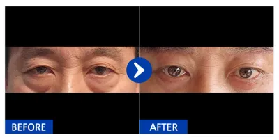 [강남언니] 하안검, 눈썹거상술 / 1개월차/ 닉네임: 비제이띠