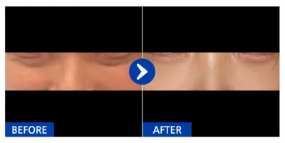 [강남언니] 눈밑지방재배치 1개월차 / 닉네임 : 미ㅣ미미미ㅣ