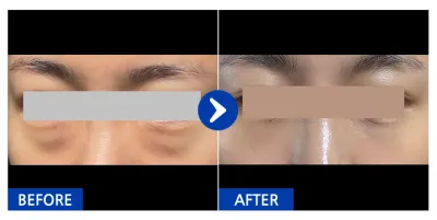 [강남언니] 눈지재 / １개월차/ 닉네임:뿌엥에우