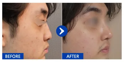 [강남언니] 코성형 / 1개월차/ 닉네임:건망고애호가