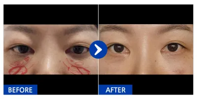 [강남언니] 눈밑지방재배치 / 1개월차/ 닉네임:유리알76