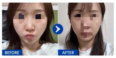 [강남언니] 광대 / 1개월차 / 닉네임 : 찌니이에옹