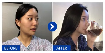 [바비톡] 코성형, 윤곽3종(광대사각턱앞턱) / 3개월차 / 닉네임 : 박땐땐