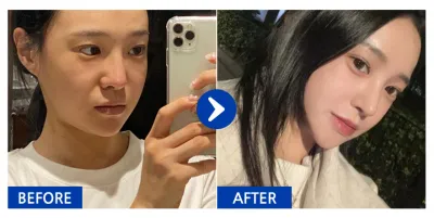 [바비톡] 코성형 / 1주차 / 닉네임 : 쿼카u0VdN