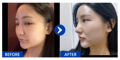 [바비톡] 코성형 / 2주차 / 닉네임 : 이뽀이쀼2