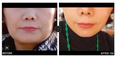 [강남언니 후기] 미니거상 / 1개월차 / 닉네임:스마일(민경)