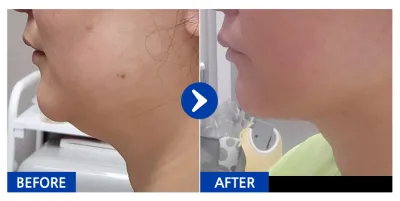 [강남언니 ] 지방흡입 / 1차 / 닉네임:서준사랑맘