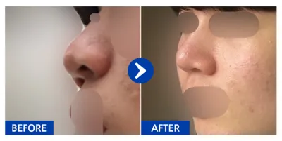 [강남언니 ] 코 / 1달차 / 닉네임:이가온12