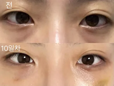 [강남언니] 눈밑지방재배치 / 10일차 / 닉네임 :  suntree