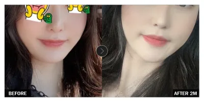 [강남언니 후기] 윤곽성형 두 달차 / 닉네임 : yrBang