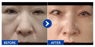 [강남언니] 하안검+지방이식 / 1개월차 / 닉네임:산수향