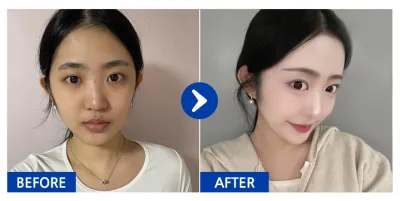 [강남언니] 코성형 / 3개월차 / 닉네임:냥냥냥웅웅