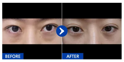 [바비톡] 눈밑지방재배치 / 1개월차 / 닉네임:냥이KdOcl