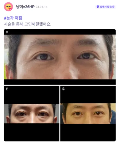 [바비톡] 눈밑지방재배치 / 2개월차 / 닉네임:냥이v26HP