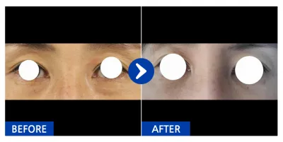 [강남언니] 눈지재 / １개월차/ 닉네임:차두리허벅지