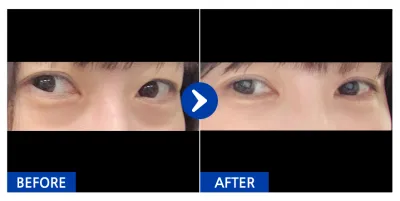 [강남언니] 눈지재 / １개월차/ 닉네임:문탠