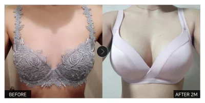 [강남언니 후기] 가슴성형 2개월차 / 닉네임 : 비띵