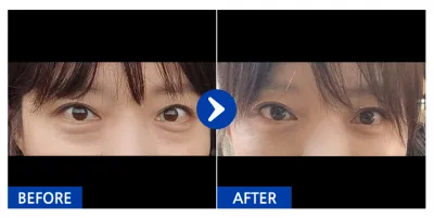 [강남언니] 눈밑지방재배치 / 1개월차 / 닉네임 : 아이스피아