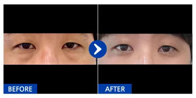 [강남언니] 눈밑지방재배치 / 1개월차 / 닉네임 : 펭베리