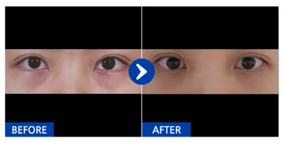 [강남언니] 눈밑지방재배치 / 1개월차 / 닉네임 : 얍씨