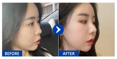 [강남언니] 코성형 / 1개월차 / 닉네임 : 드르르륵드르륵