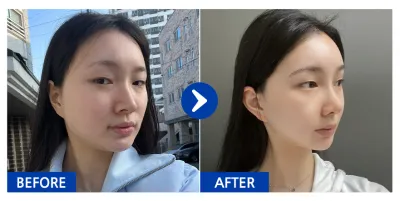 [강남언니] 코성형, 윤곽2종(광대, 사각) / 1개월차 / 닉네임 : 코알리어