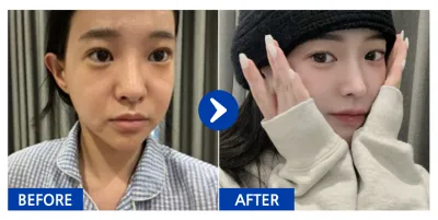 [강남언니] 코재수술 / 2개월차 / 닉네임 : 하이루익바