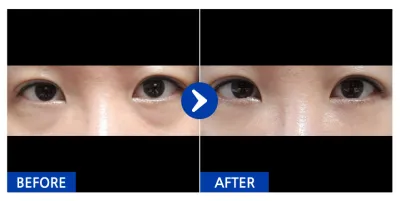 [강남언니] 눈밑지방재배치 / 1개월차 / 닉네임 : 나에요ㄴ