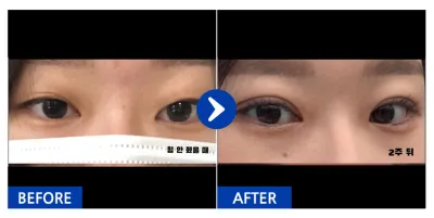 [강남언니] 자연유착 / 1개월차 / 닉네임:easyn