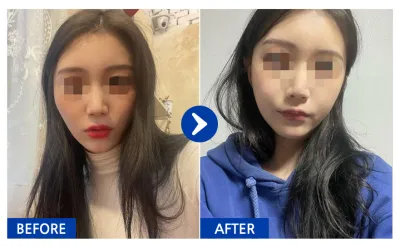 [바비톡] 안면윤곽 / 1개월차 / 닉네임 : 보르으음달