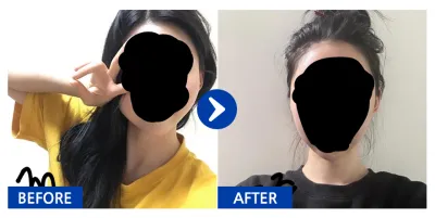 [강남언니] 광대,사각턱 1개월차 / 닉네임 : 아러라라라라랑