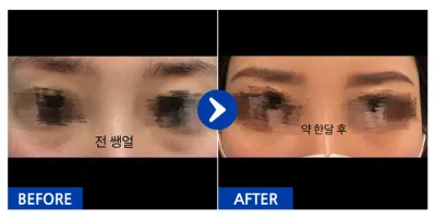 [강남언니] 눈밑지방재배치 / 1개월차 / 닉네임: 쑈롱