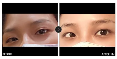 [강남언니 후기] 눈성형 한 달차 / 닉네임 : 피곤한아르마딜로