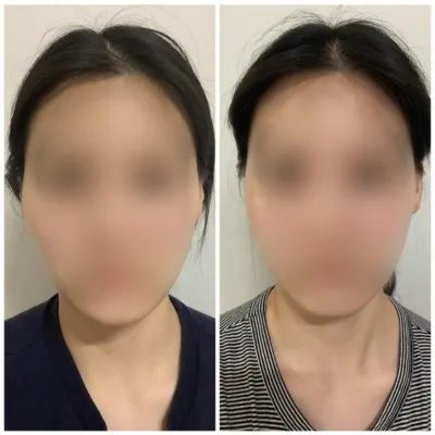 [강남언니 후기] 윤곽성형 한 달차 / 닉네임 : 도비메라