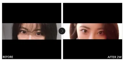 [바비톡 후기] 눈밑지방재배치 2주차 / 닉네임 : 매이라