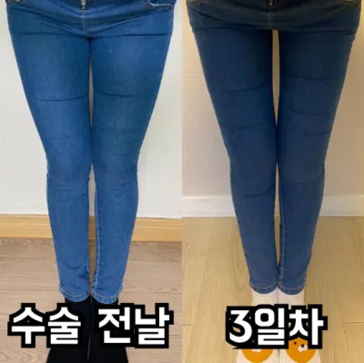 [강남언니 후기] 허벅지지방흡입 3일차 / 닉네임 : 뽀링꼬