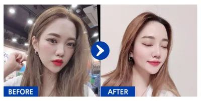 [바비톡] 코성형 / 5개월차/ 닉네임:둉둉이잉