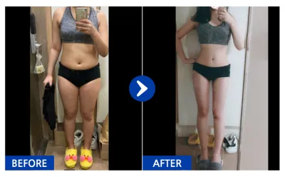 [강남언니] 전신지방흡입 / 3개월차/ 닉네임:솜사탕모구