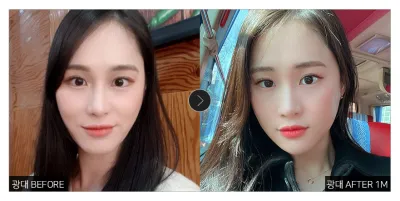 [강남언니 후기]  광대축소술 한 달차 / 닉네임 : 희니마니무