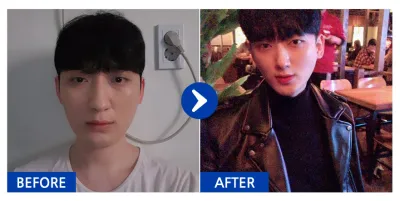 [강남언니] 코성형 / 4개월차/ 닉네임:핵규