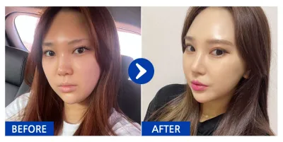 [강남언니] 코성형 / 5개월차/ 닉네임:검은진주