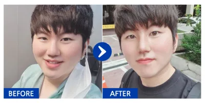 [강남언니] 코성형 / 5개월차/ 닉네임:본주로남