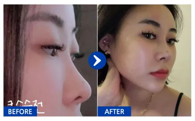 [바비톡] 코성형 / 2개월차/ 닉네임:꽃슈니이