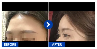 [강남언니] 지방이식 / 2개월차/ 닉네임:영ㅇ0